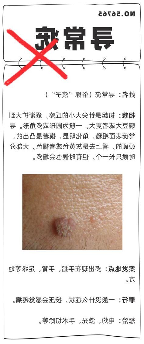 hpv 痣